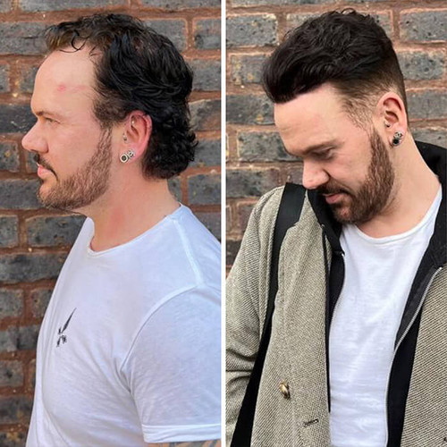 پروتز جلو سر مردانه